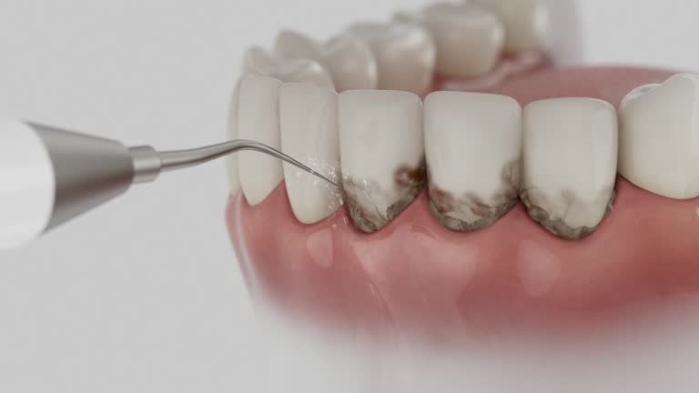 Trusted Dental Crowns And Bridges service in Westerville, OH - Dentist Open Now